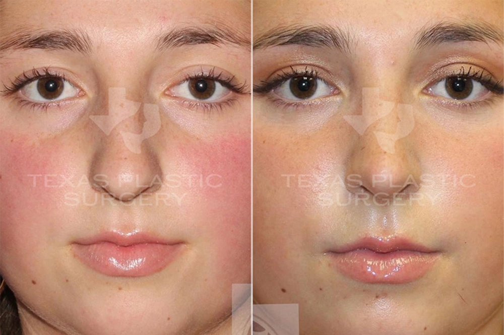 Real Patient results in San Antonio, TX Performed by Texas Plastic Surgery