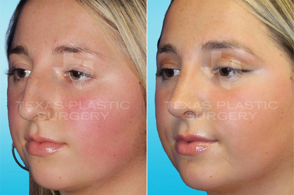 Real Patient results in San Antonio, TX Performed by Texas Plastic Surgery