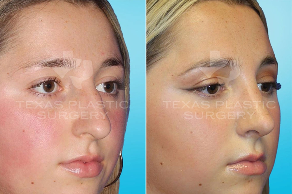 Real Patient results in San Antonio, TX Performed by Texas Plastic Surgery
