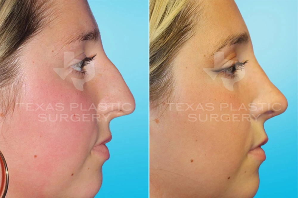 Real Patient results in San Antonio, TX Performed by Texas Plastic Surgery