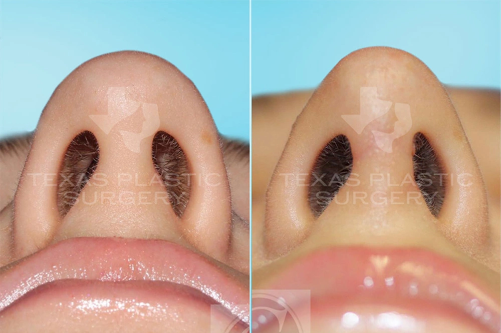 Real Patient results in San Antonio, TX Performed by Texas Plastic Surgery