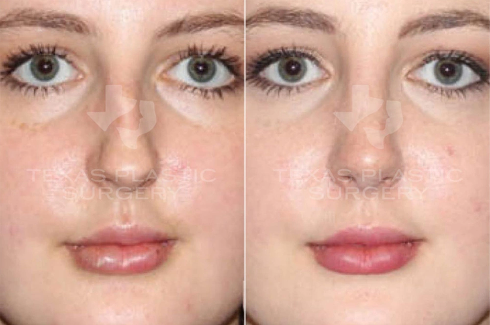 Real Patient results in San Antonio, TX Performed by Texas Plastic Surgery