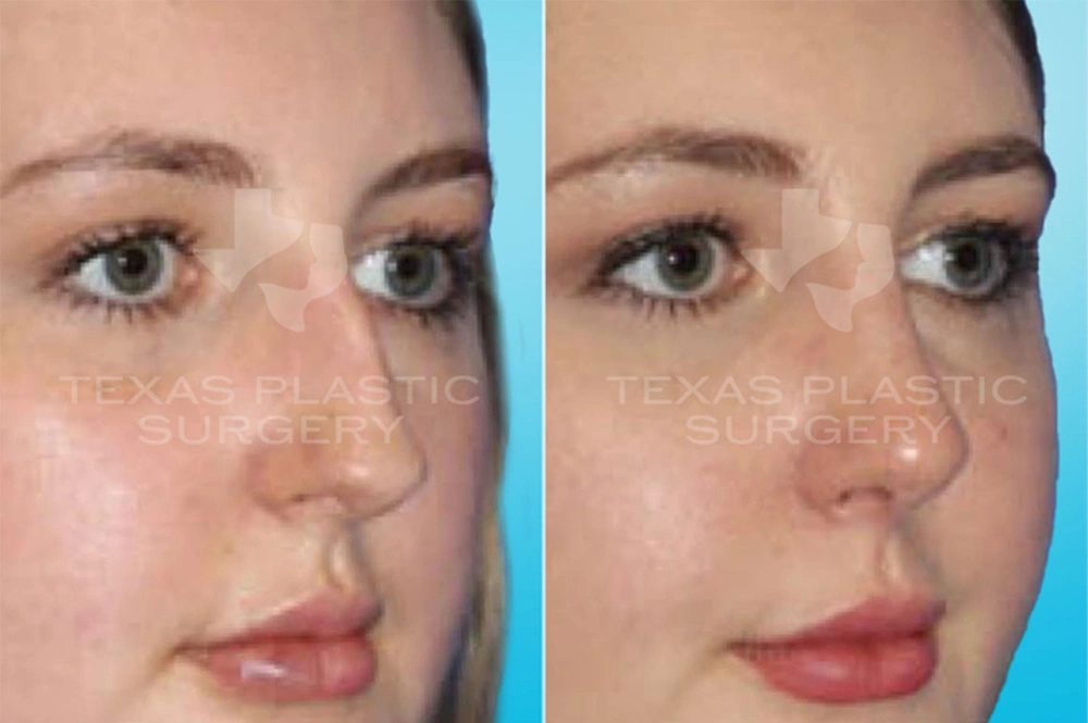 Real Patient results in San Antonio, TX Performed by Texas Plastic Surgery