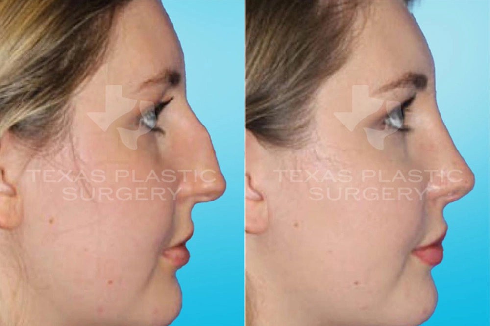 Real Patient results in San Antonio, TX Performed by Texas Plastic Surgery