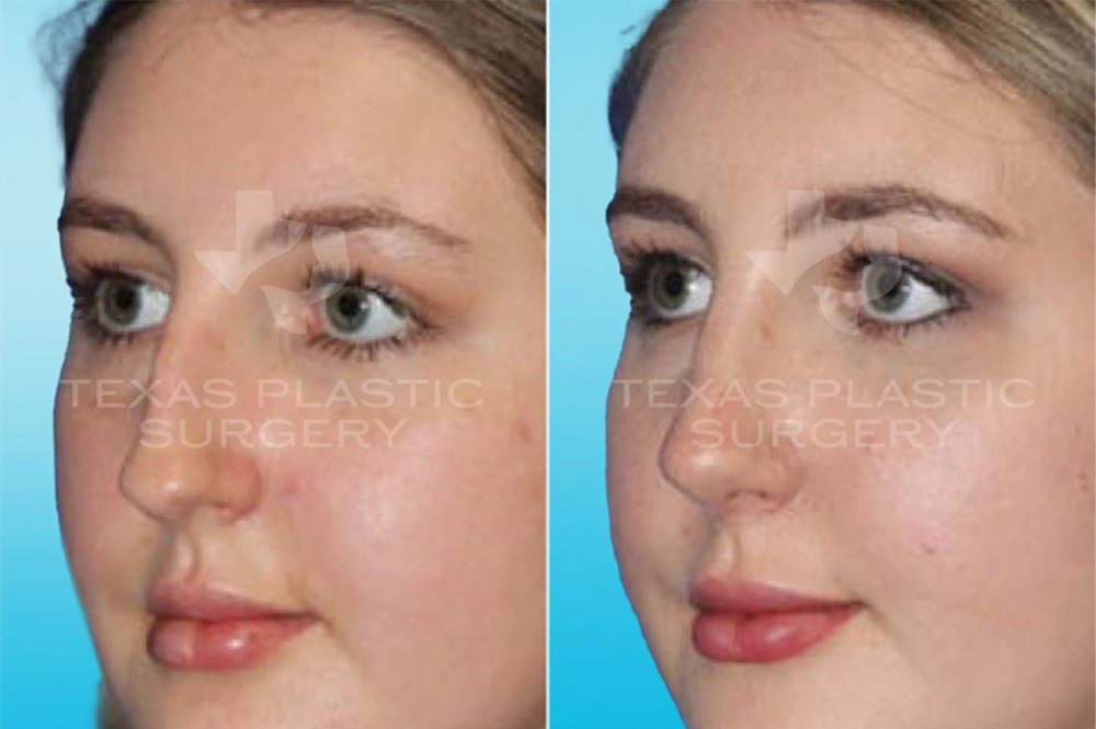Real Patient results in San Antonio, TX Performed by Texas Plastic Surgery