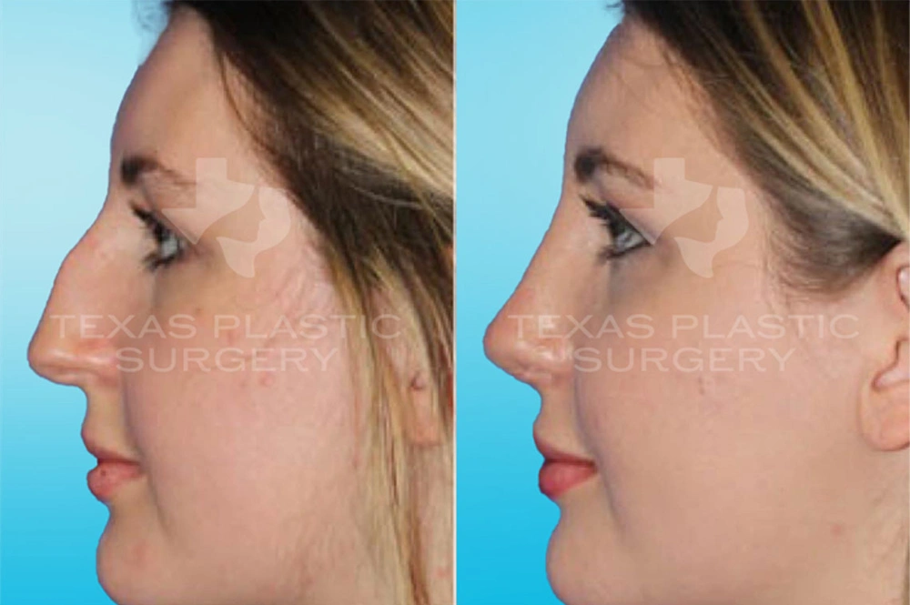 Real Patient results in San Antonio, TX Performed by Texas Plastic Surgery