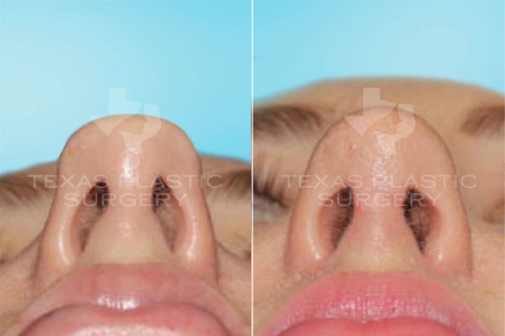 Real Patient results in San Antonio, TX Performed by Texas Plastic Surgery