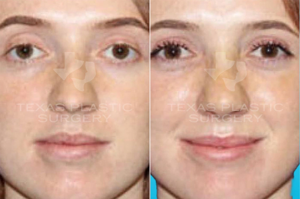 Real Patient results in San Antonio, TX Performed by Texas Plastic Surgery