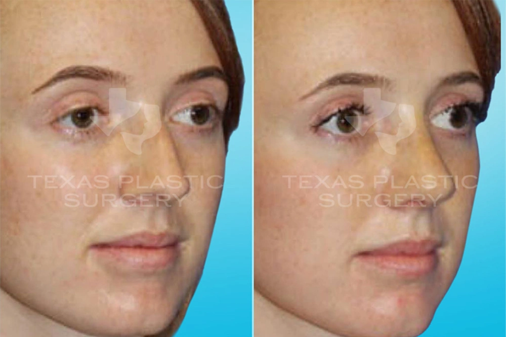 Real Patient results in San Antonio, TX Performed by Texas Plastic Surgery
