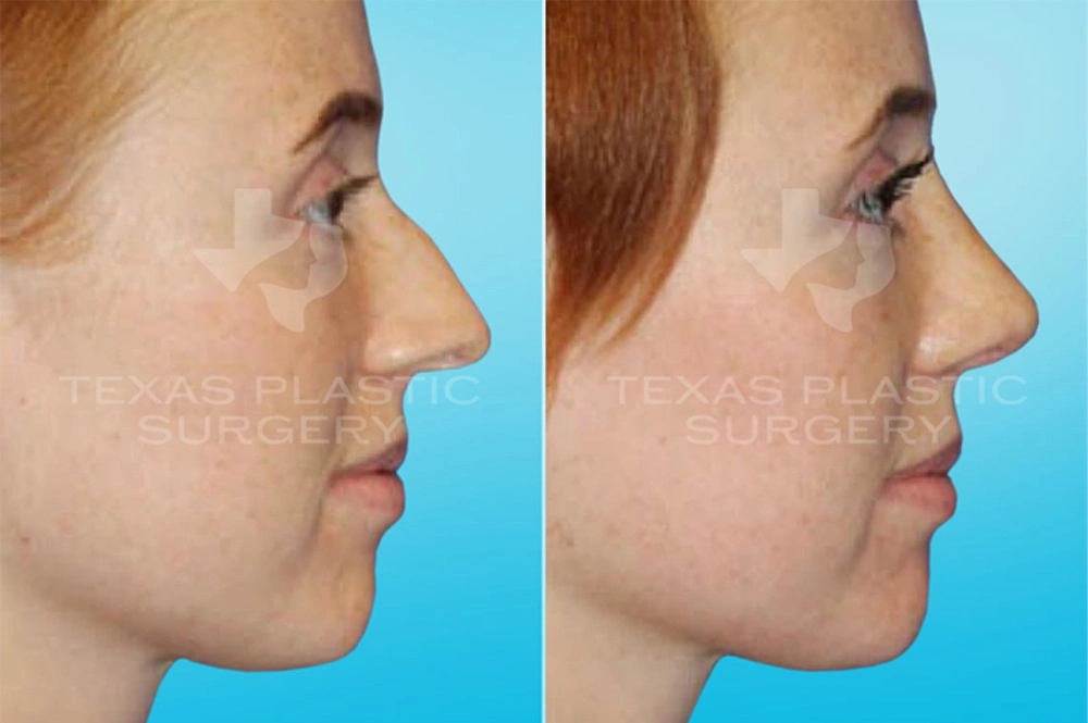 Real Patient results in San Antonio, TX Performed by Texas Plastic Surgery