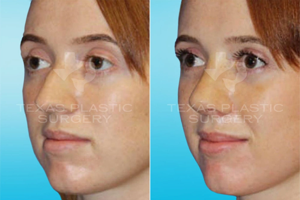 Real Patient results in San Antonio, TX Performed by Texas Plastic Surgery