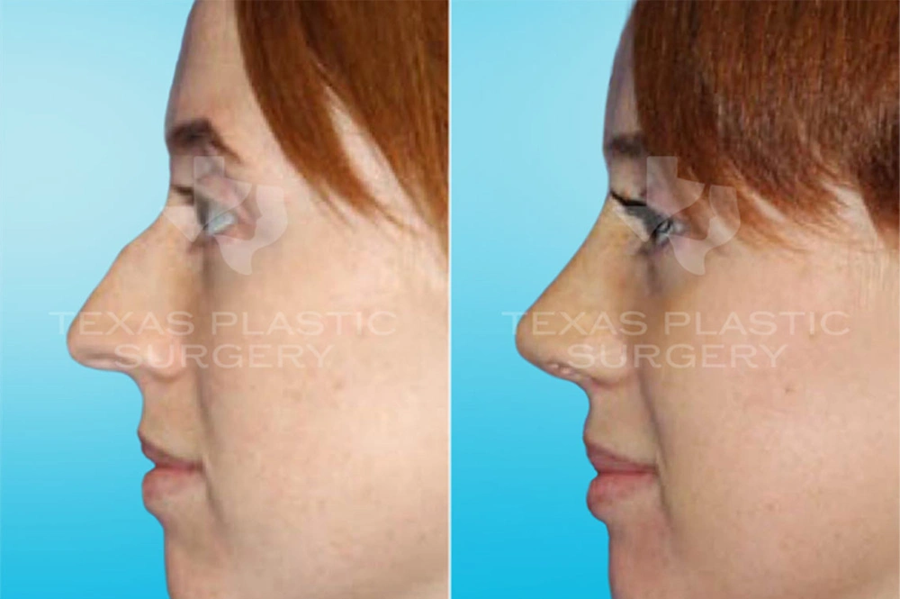 Real Patient results in San Antonio, TX Performed by Texas Plastic Surgery