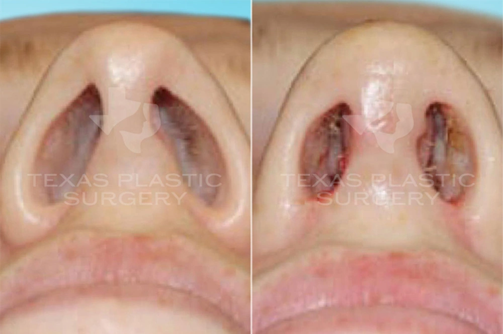 Real Patient results in San Antonio, TX Performed by Texas Plastic Surgery