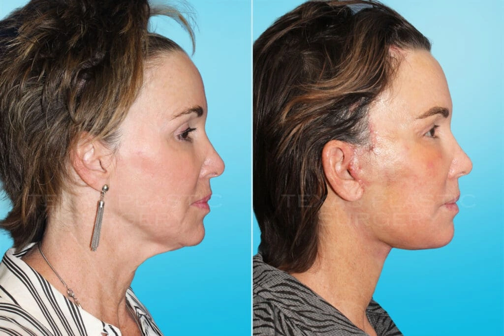Real Patient results in San Antonio, TX Performed by Texas Plastic Surgery