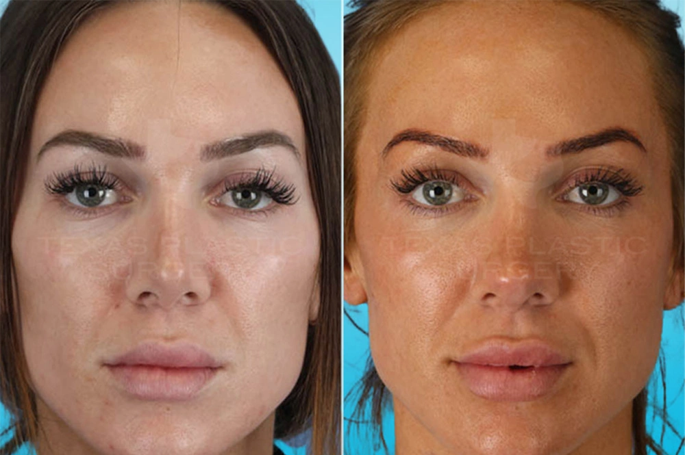 Real Patient results in San Antonio, TX Performed by Texas Plastic Surgery