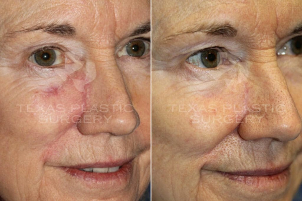 Real Patient results in San Antonio, TX Performed by Texas Plastic Surgery