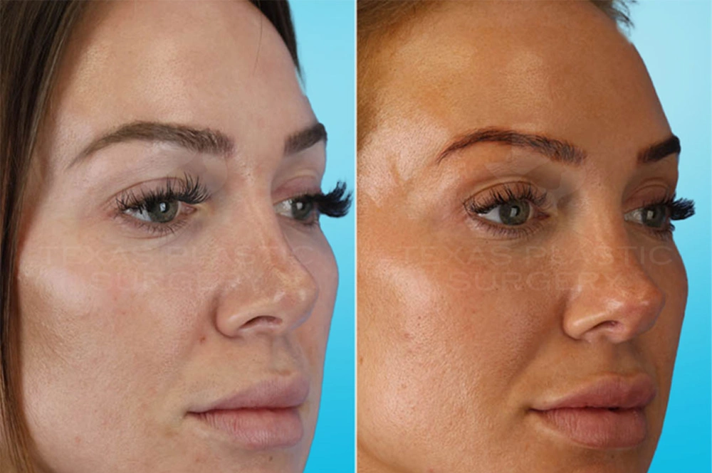 Real Patient results in San Antonio, TX Performed by Texas Plastic Surgery
