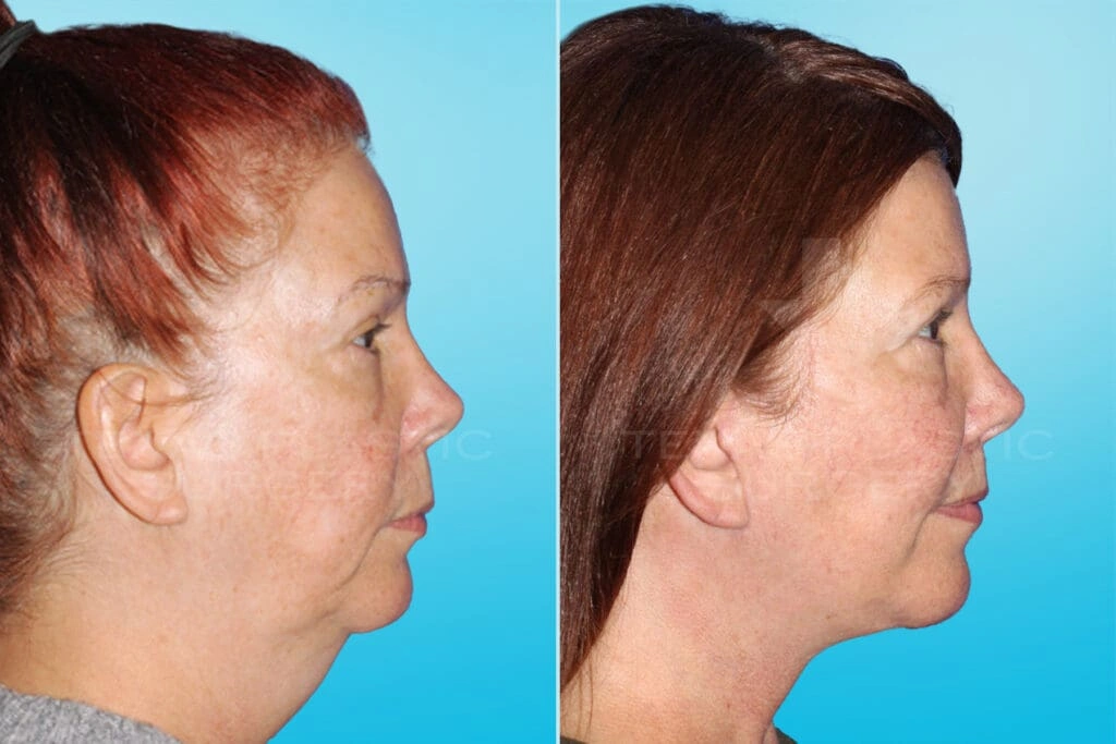Real Patient results in San Antonio, TX Performed by Texas Plastic Surgery