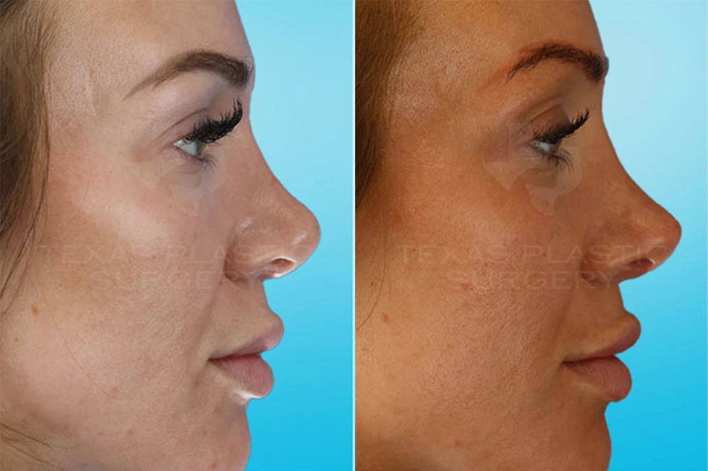 Real Patient results in San Antonio, TX Performed by Texas Plastic Surgery