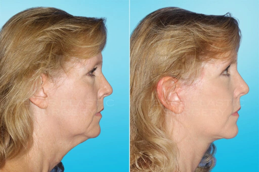 Real Patient results in San Antonio, TX Performed by Texas Plastic Surgery
