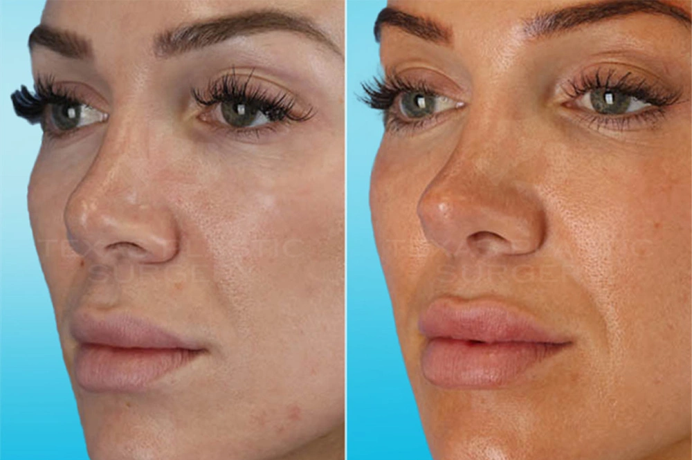 Real Patient results in San Antonio, TX Performed by Texas Plastic Surgery
