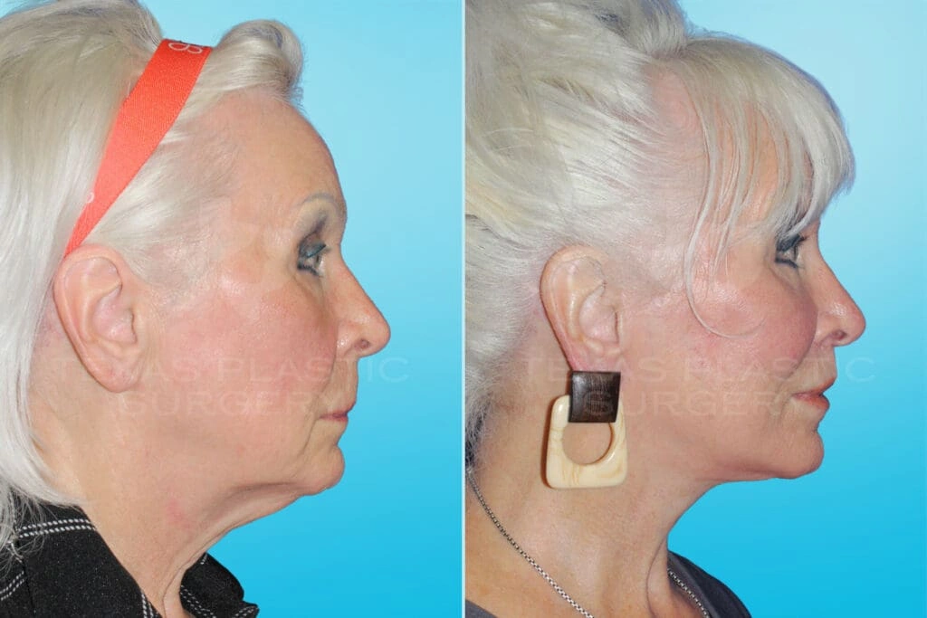 Real Patient results in San Antonio, TX Performed by Texas Plastic Surgery