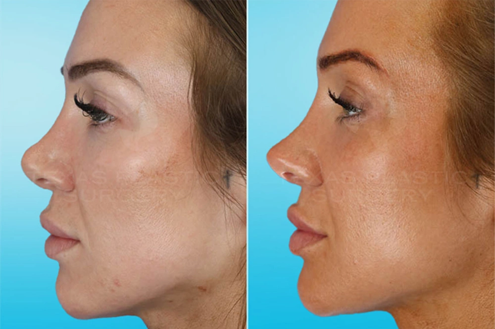 Real Patient results in San Antonio, TX Performed by Texas Plastic Surgery