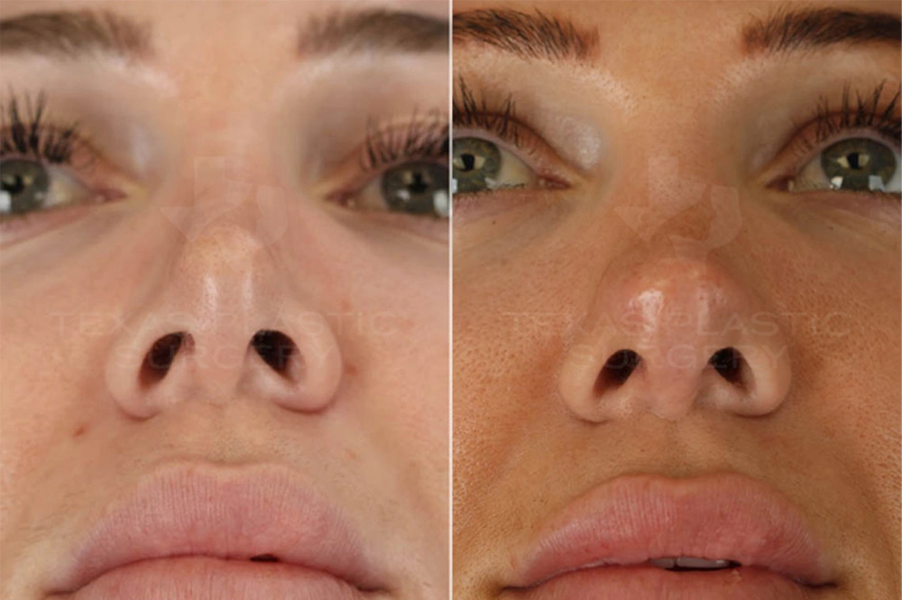 Real Patient results in San Antonio, TX Performed by Texas Plastic Surgery