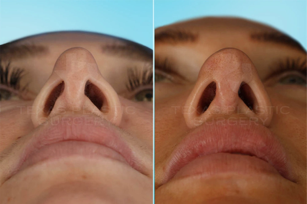 Real Patient results in San Antonio, TX Performed by Texas Plastic Surgery