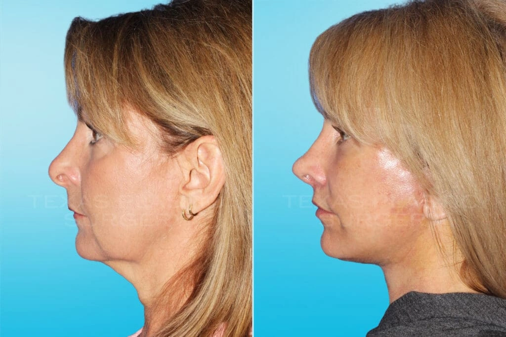 Real Patient results in San Antonio, TX Performed by Texas Plastic Surgery
