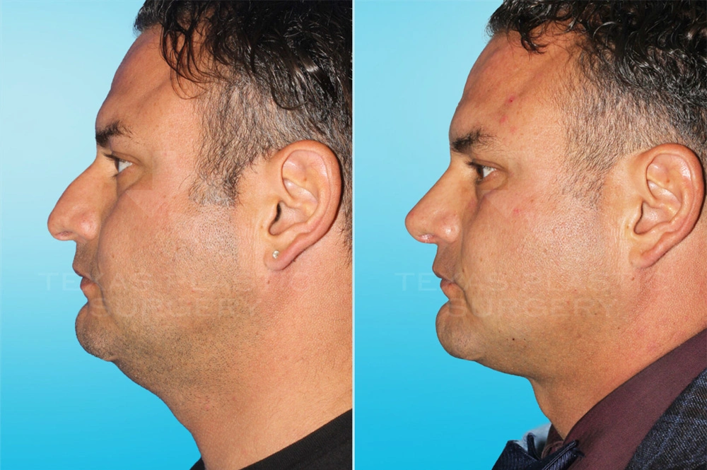 Real Patient results in San Antonio, TX Performed by Texas Plastic Surgery