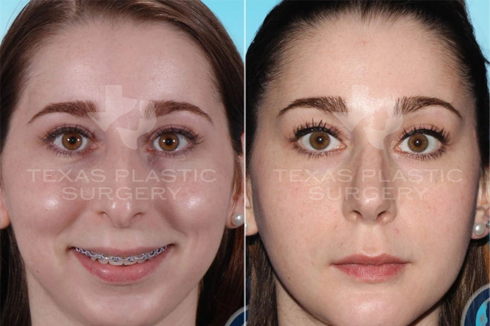 Real Patient results in San Antonio, TX Performed by Texas Plastic Surgery