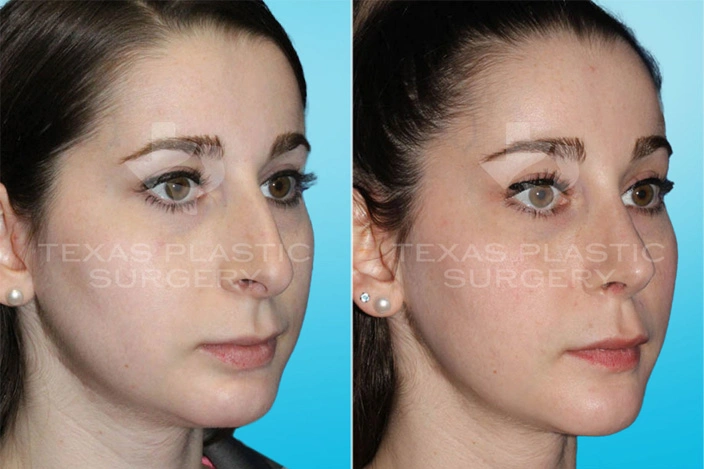 Real Patient results in San Antonio, TX Performed by Texas Plastic Surgery