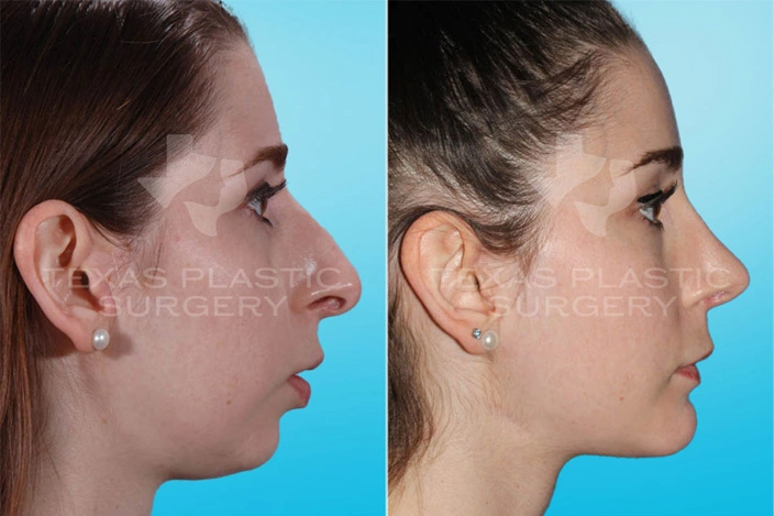 Real Patient results in San Antonio, TX Performed by Texas Plastic Surgery