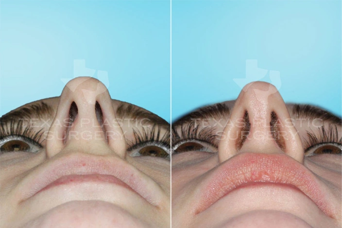 Real Patient results in San Antonio, TX Performed by Texas Plastic Surgery