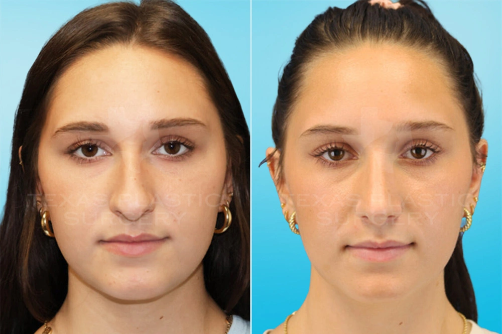 Real Patient results in San Antonio, TX Performed by Texas Plastic Surgery