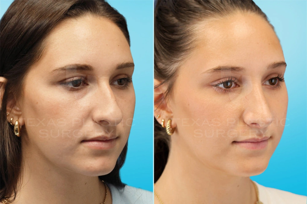 Real Patient results in San Antonio, TX Performed by Texas Plastic Surgery