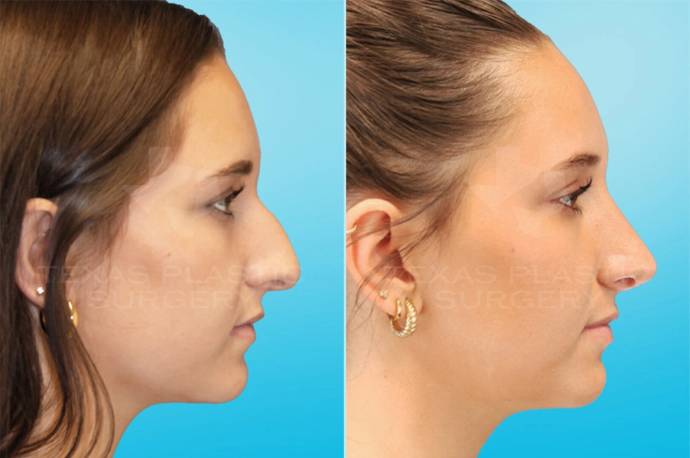 Real Patient results in San Antonio, TX Performed by Texas Plastic Surgery