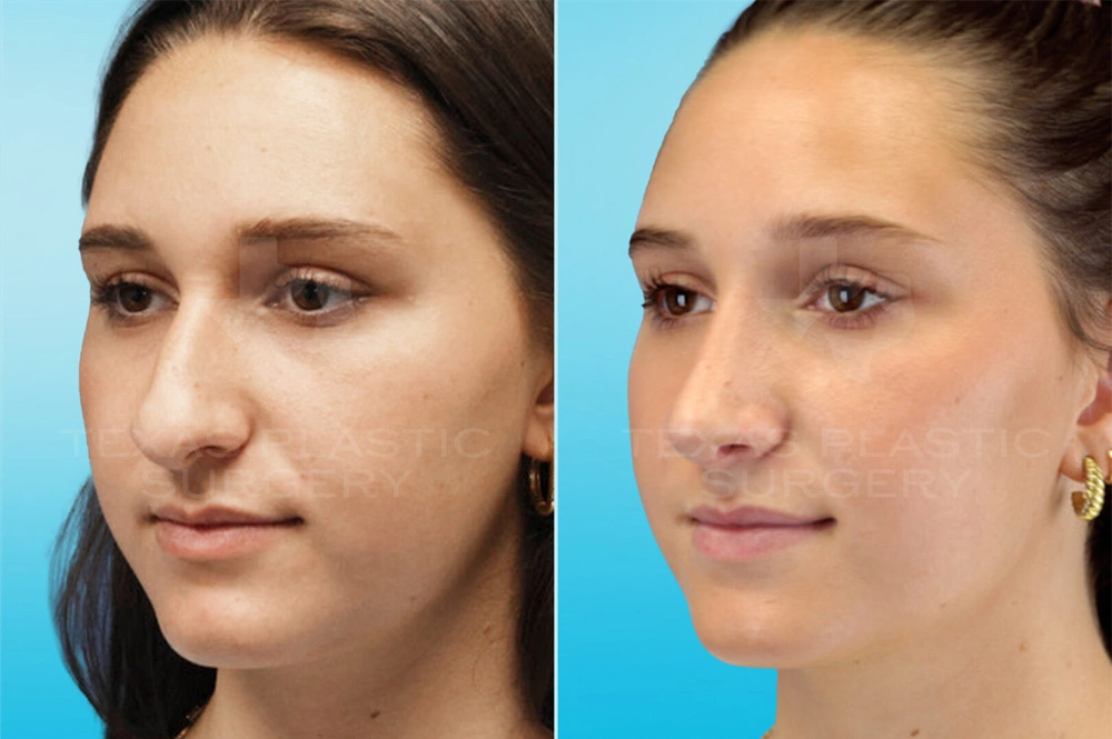 Real Patient results in San Antonio, TX Performed by Texas Plastic Surgery