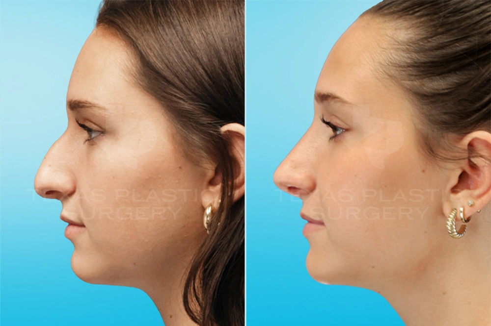 Real Patient results in San Antonio, TX Performed by Texas Plastic Surgery