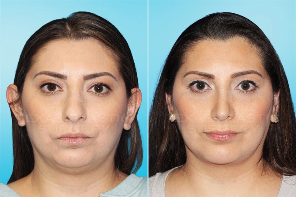 Real Patient results in San Antonio, TX Performed by Texas Plastic Surgery