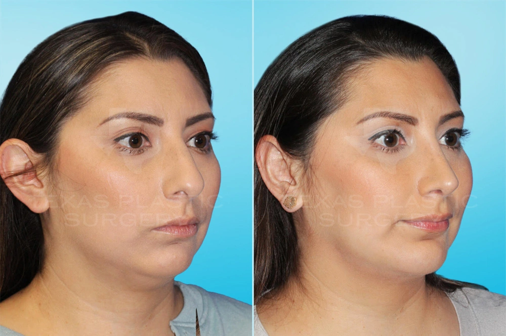 Real Patient results in San Antonio, TX Performed by Texas Plastic Surgery