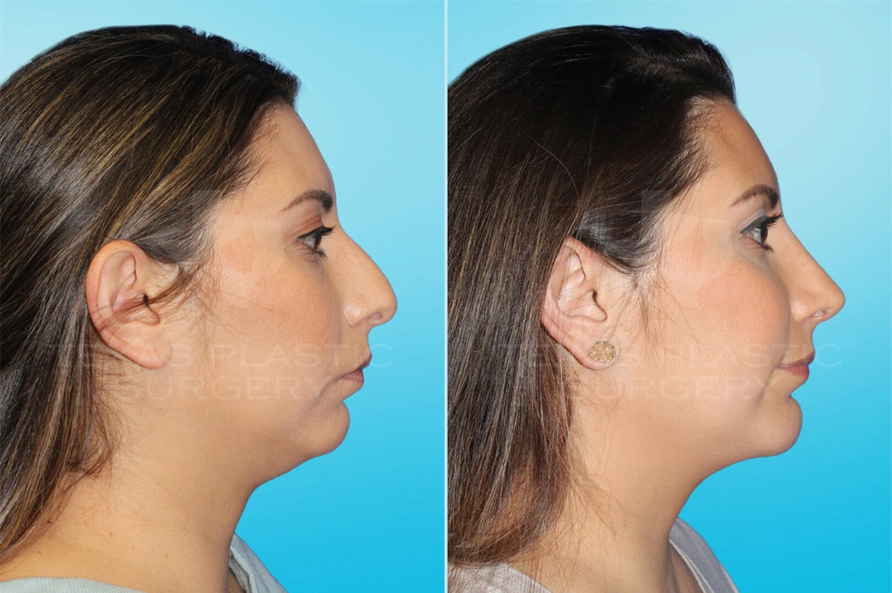 Real Patient results in San Antonio, TX Performed by Texas Plastic Surgery