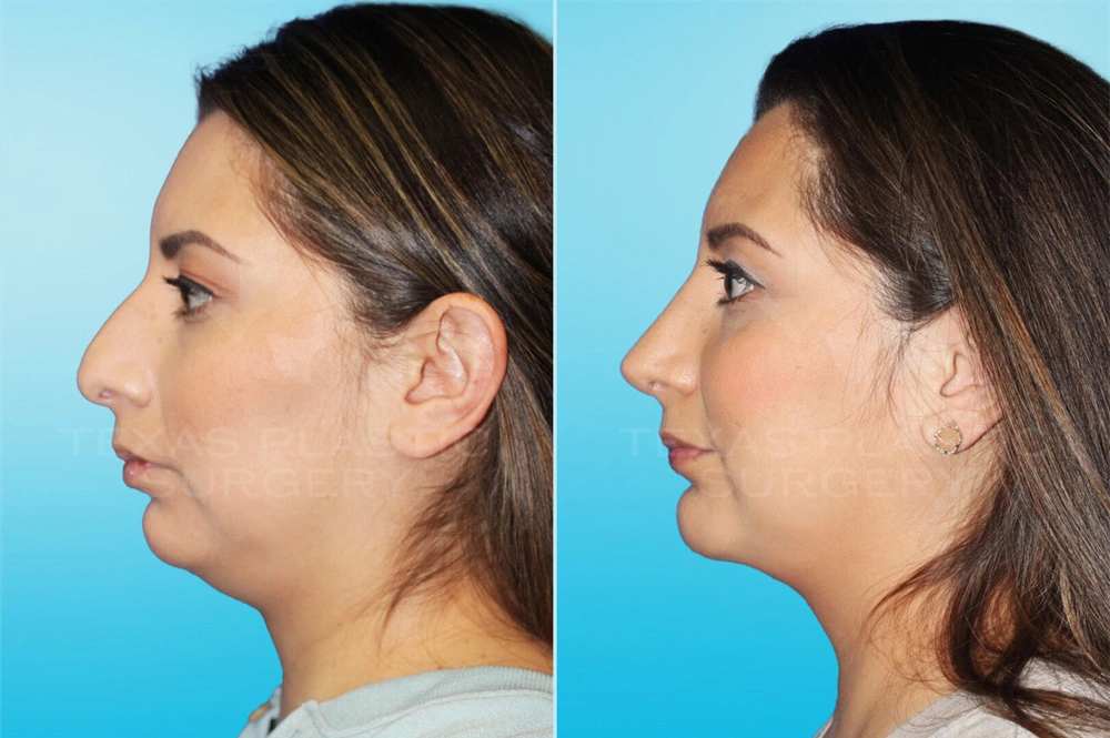 Real Patient results in San Antonio, TX Performed by Texas Plastic Surgery