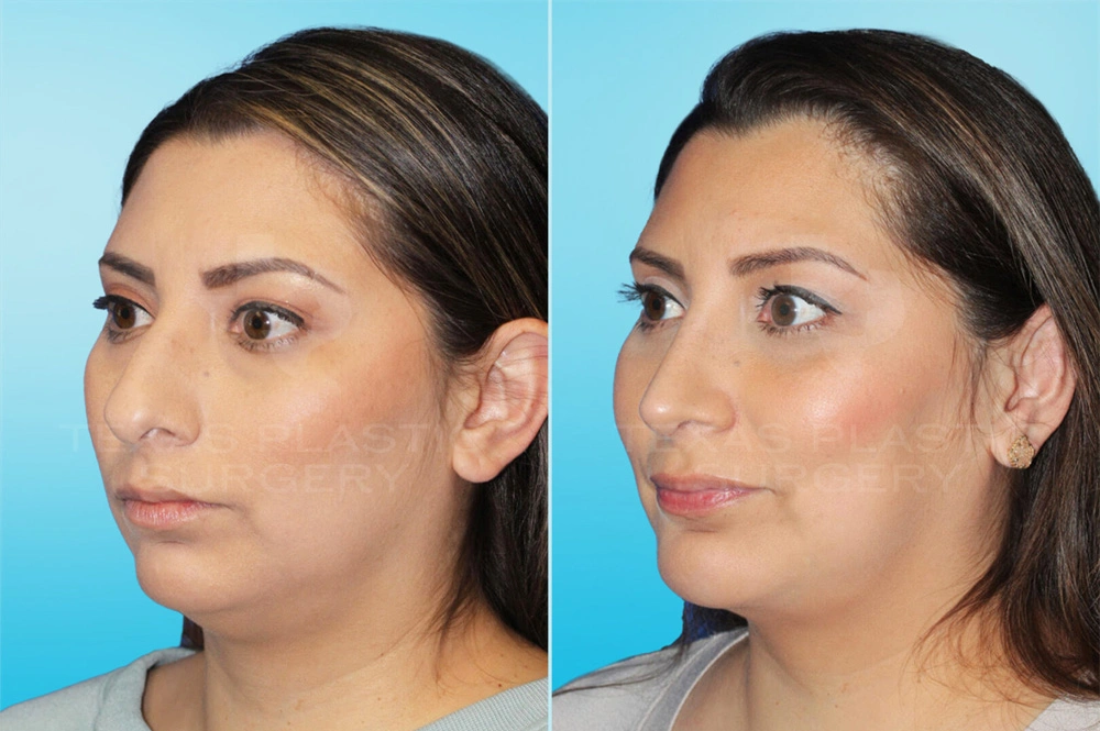 Real Patient results in San Antonio, TX Performed by Texas Plastic Surgery
