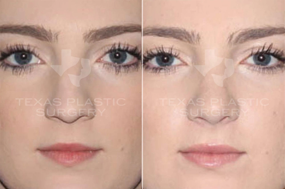 Real Patient results in San Antonio, TX Performed by Texas Plastic Surgery