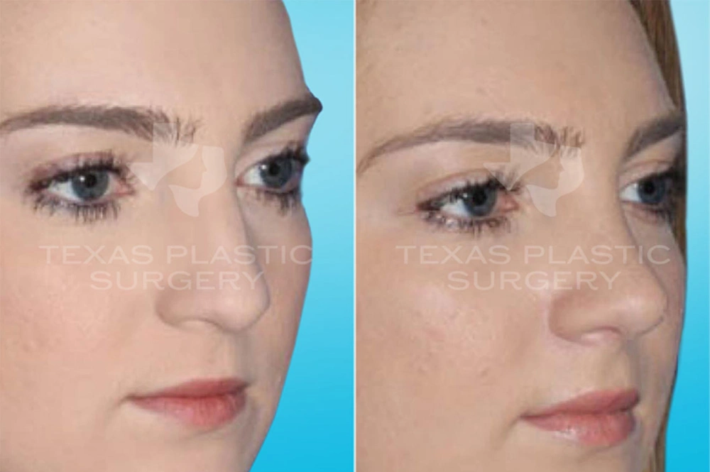 Real Patient results in San Antonio, TX Performed by Texas Plastic Surgery