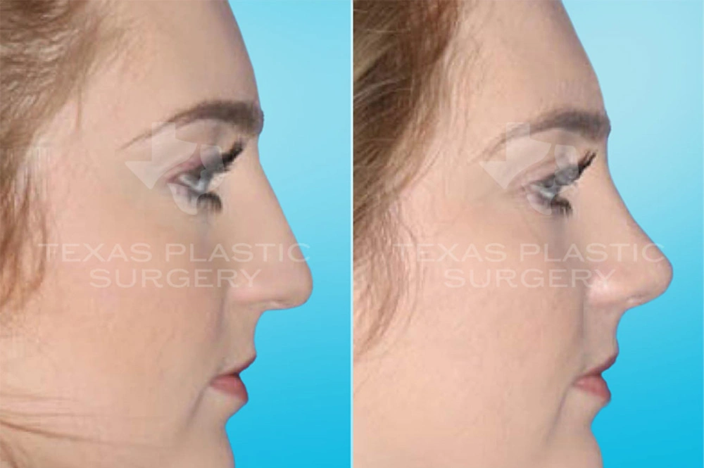 Real Patient results in San Antonio, TX Performed by Texas Plastic Surgery