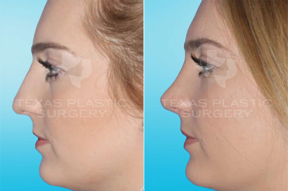 Real Patient results in San Antonio, TX Performed by Texas Plastic Surgery