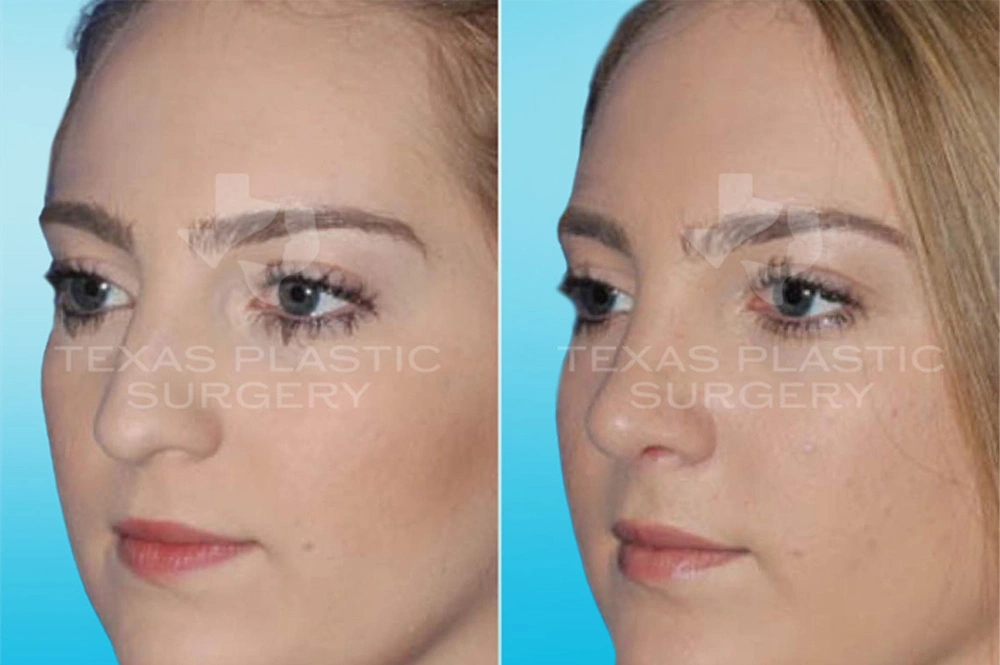 Real Patient results in San Antonio, TX Performed by Texas Plastic Surgery